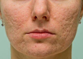 Acne Scars Treatment in mumbai india