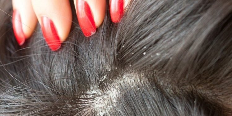 Seborrheic Dermatitis & Dandruff Treatment in mumbai, india