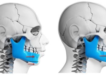 Orthognathic Jaw Surgery in mumbai, india