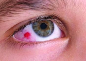 Common Eye Tumor in Children – Retinoblastoma in mumbai india