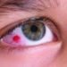 Common Eye Tumor in Children – Retinoblastoma in mumbai india