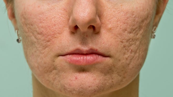 Acne Scar Laser Treatment-The Best Solution For Your Acne Scarring