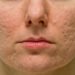 Acne Scar Laser Treatment-The Best Solution For Your Acne Scarring