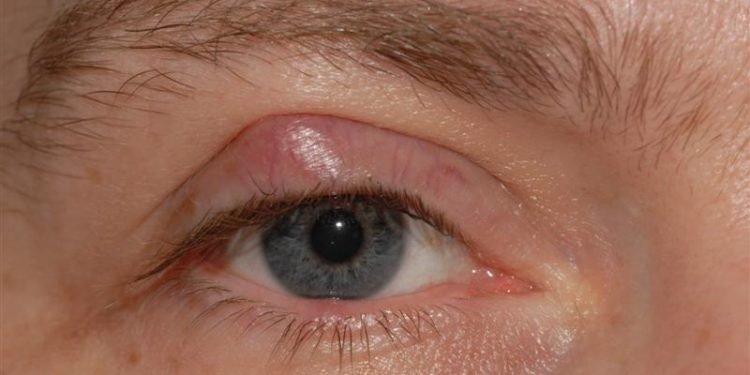 Conjunctival cyst removal Know what to do