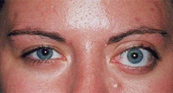 Orbital Tumor Explore the Treatment Options