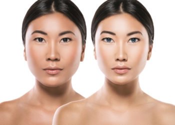 Jaw Correction Surgery - The Best Solution for Many Facial Irregularities