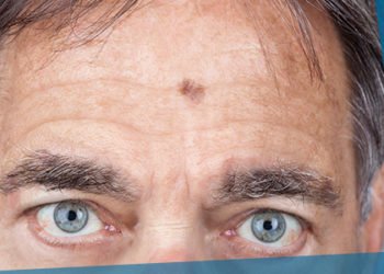 A guide to advanced skin cancer treatment in India