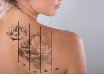 Get effective & easier tattoo removal treatment in India - visit The Esthetic Clinics