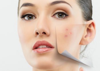 Say goodbye to annoying acne issues - Get acne scar treatment in mumbai India