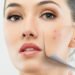 Say goodbye to annoying acne issues - Get acne scar treatment in mumbai India