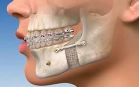 What are the problems overcome by Jaw Correction Surgery