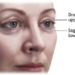 Benefits Of Blepharoplasty Surgery In Mumbai