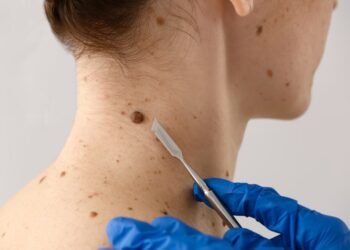Different Methods And Considerations For Mole or Wart Removal