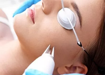 Fractional CO2 Laser Treatment Side Effects