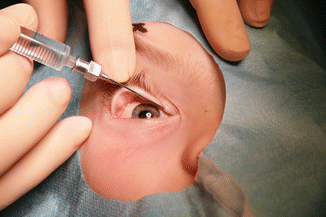 Lacrimal Surgery Explained