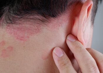 Psoriasis diagnosis and treatment in Mumbai