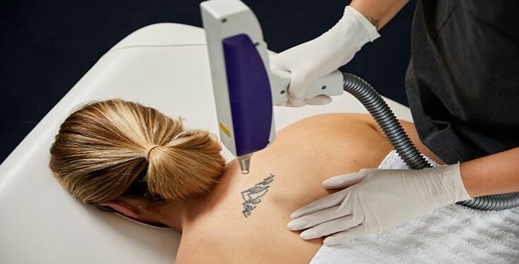 Risks And Benefits Of Tattoo Removal Treatment