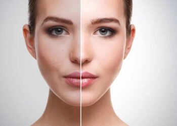 Skin Whitening Treatment, Procedures, Cost, And Side Effects