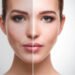 Skin Whitening Treatment, Procedures, Cost, And Side Effects