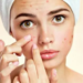 The Best Treatment For Acne In Mumbai