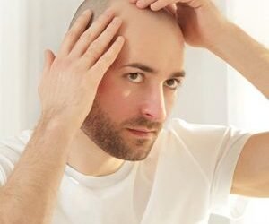 The Top 3 Essential Considerations Before Opting For a Hair Transplant