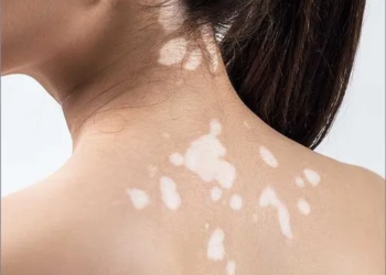 Understanding Vitiligo Causes And Treatment