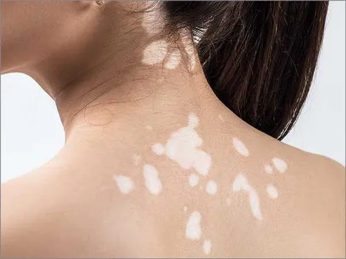 Understanding Vitiligo Causes And Treatment