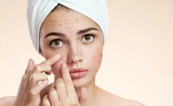 5 Reasons Your Acne Keeps Returning and Getting Worse