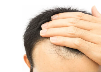 Advantages of Hair Transplant surgery