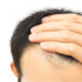 Advantages of Hair Transplant surgery