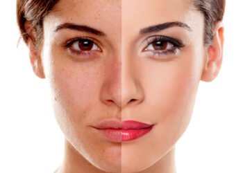 Can Pigmentation Come Back After Treatment?