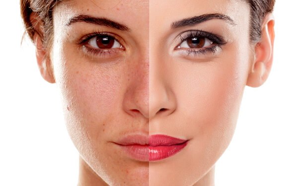 Can Pigmentation Come Back After Treatment?