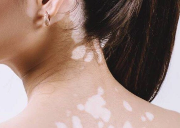 Can Vitiligo Completely Go Away?