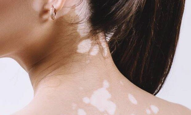 Can Vitiligo Completely Go Away?