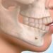 Choosing the Right Surgeon for Orthognathic Surgery