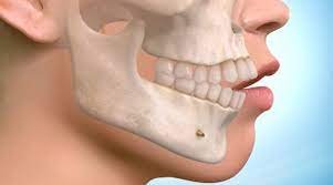 Choosing the Right Surgeon for Orthognathic Surgery