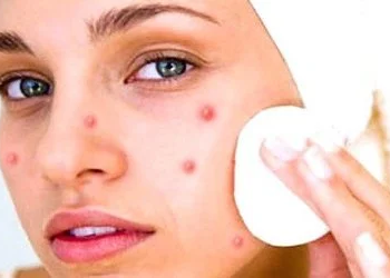 How to Prevent Acne and pimples, causes and prevention