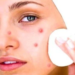 How to Prevent Acne and pimples, causes and prevention