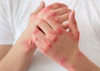 Psoriasis Triggers and How to Stop it From Spreading