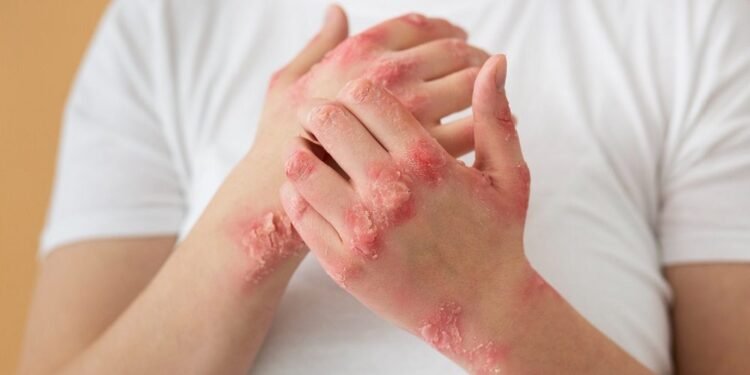 Psoriasis Triggers and How to Stop it From Spreading
