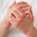 Psoriasis Triggers and How to Stop it From Spreading