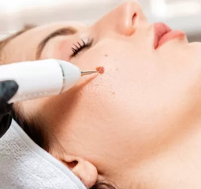 What are the Benefits of Removing a Birthmark?